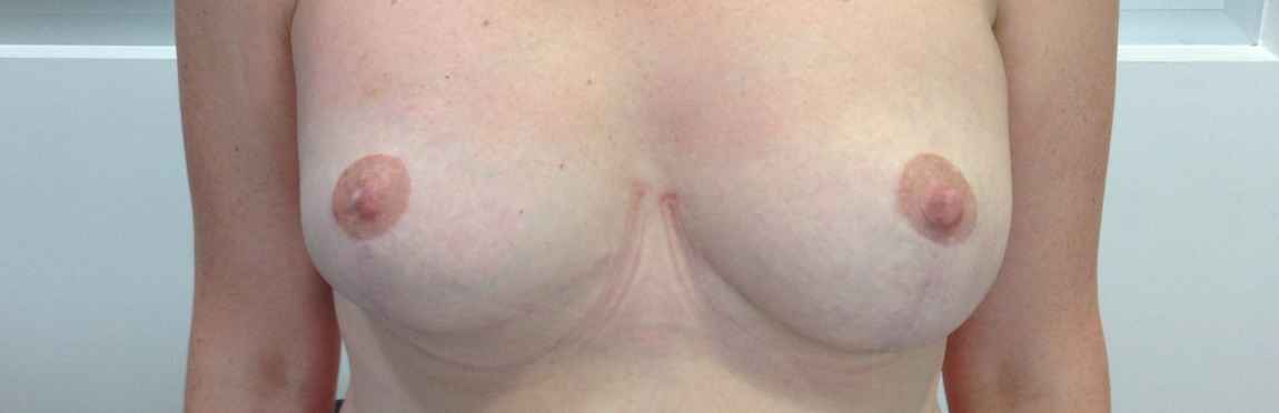 Foto Tratamiento de fisioterapia en el postoperatorio de mama